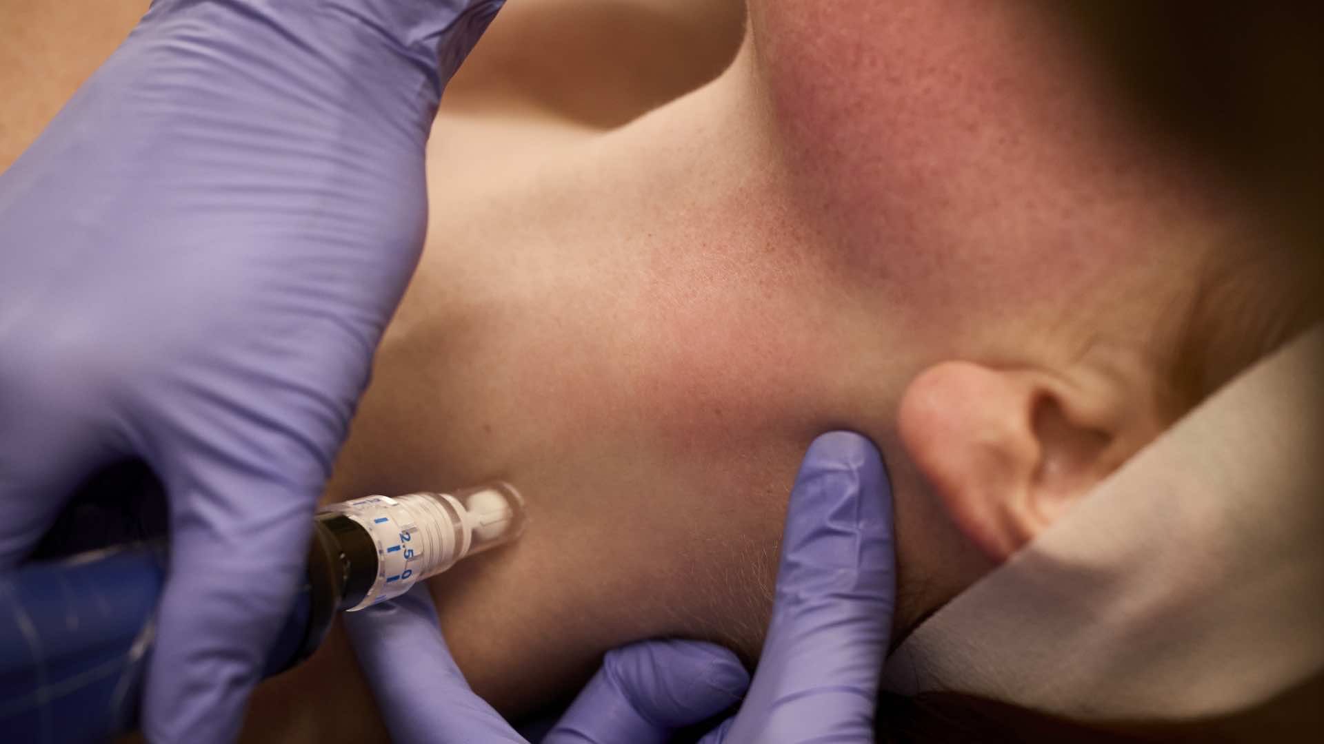 skinpen neck