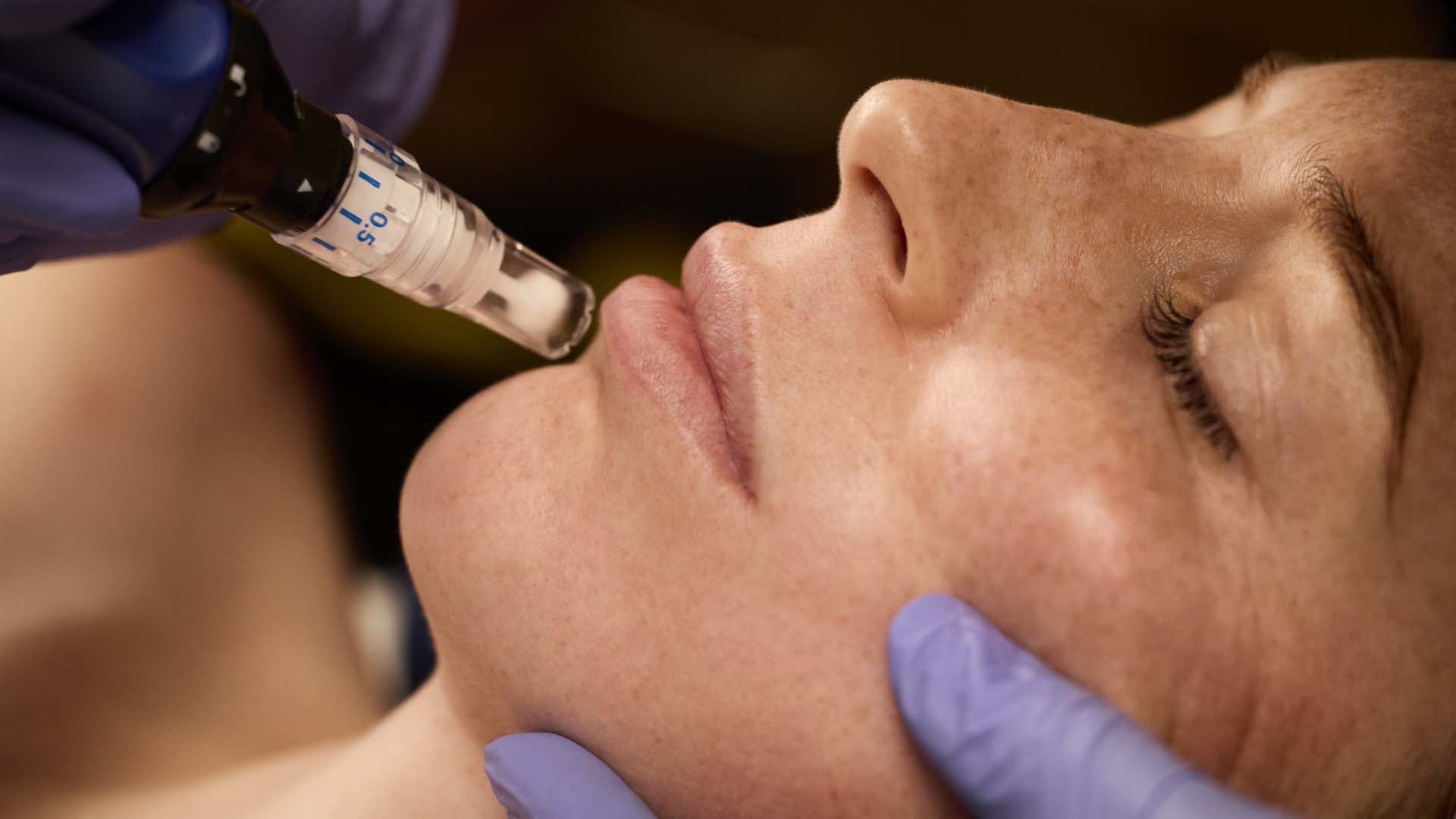 SkinPen acne treatment
